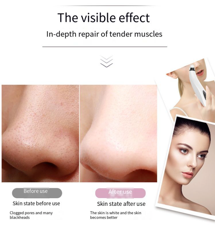 (US Shipping) Electric Blackhead Remover Cleaner Face Diamond Pore Vacuum Suction White Heads